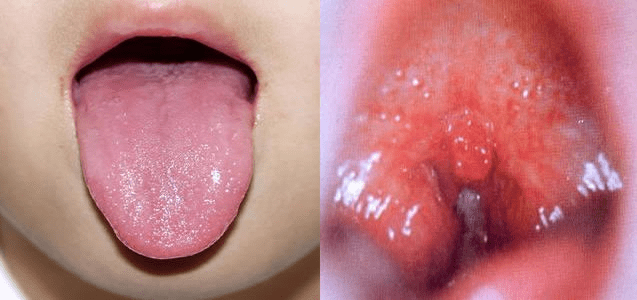 溶連菌感染症の写真