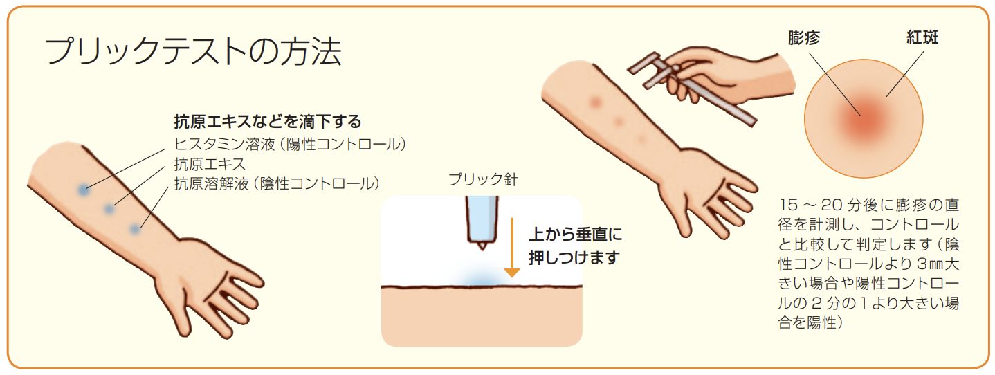 皮膚プリック試験の図