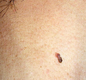 軟性線維腫（スキンタッグ・首イボ）の写真