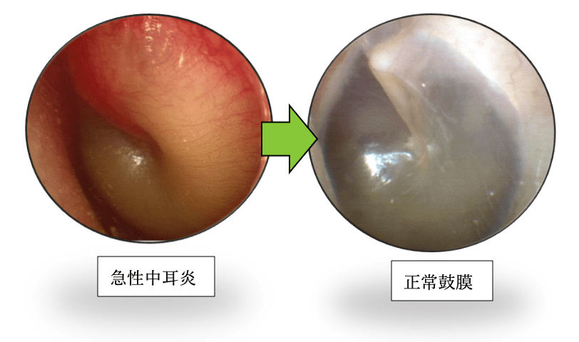 急性中耳炎