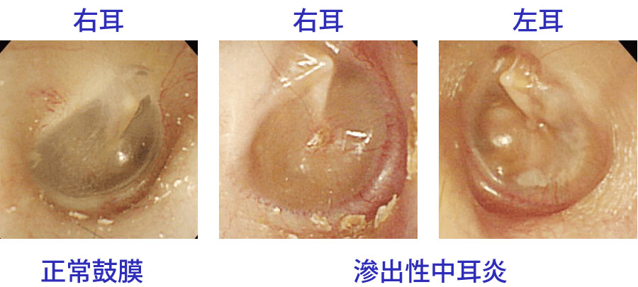 滲出性（しんしゅつ）中耳炎の写真