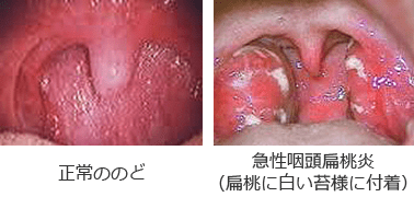 扁桃炎の写真